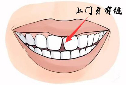 女人门牙有缝面相好吗 有没有福气？