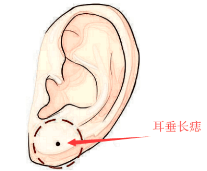 旺财痣, 身上此处长善痣, 发横财, 进偏财, 看你脸上得是不是