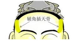 3.辅角插天骨