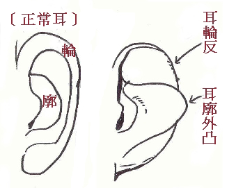 解析面相中的反廓耳